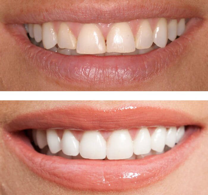 dental teeth bonding 700x656 new