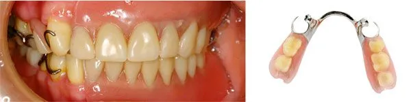 traditional partial denture (4)